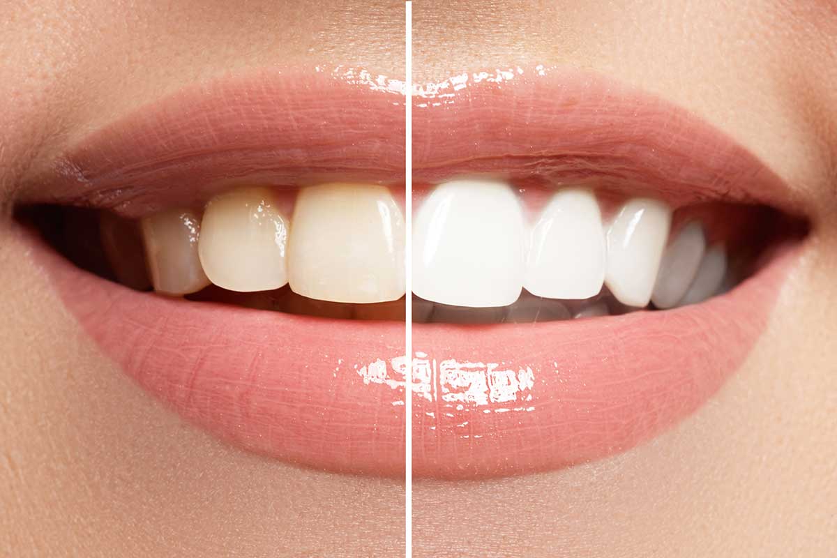 Is it harmful to my teeth to get them whitened? Advanced Dental Care