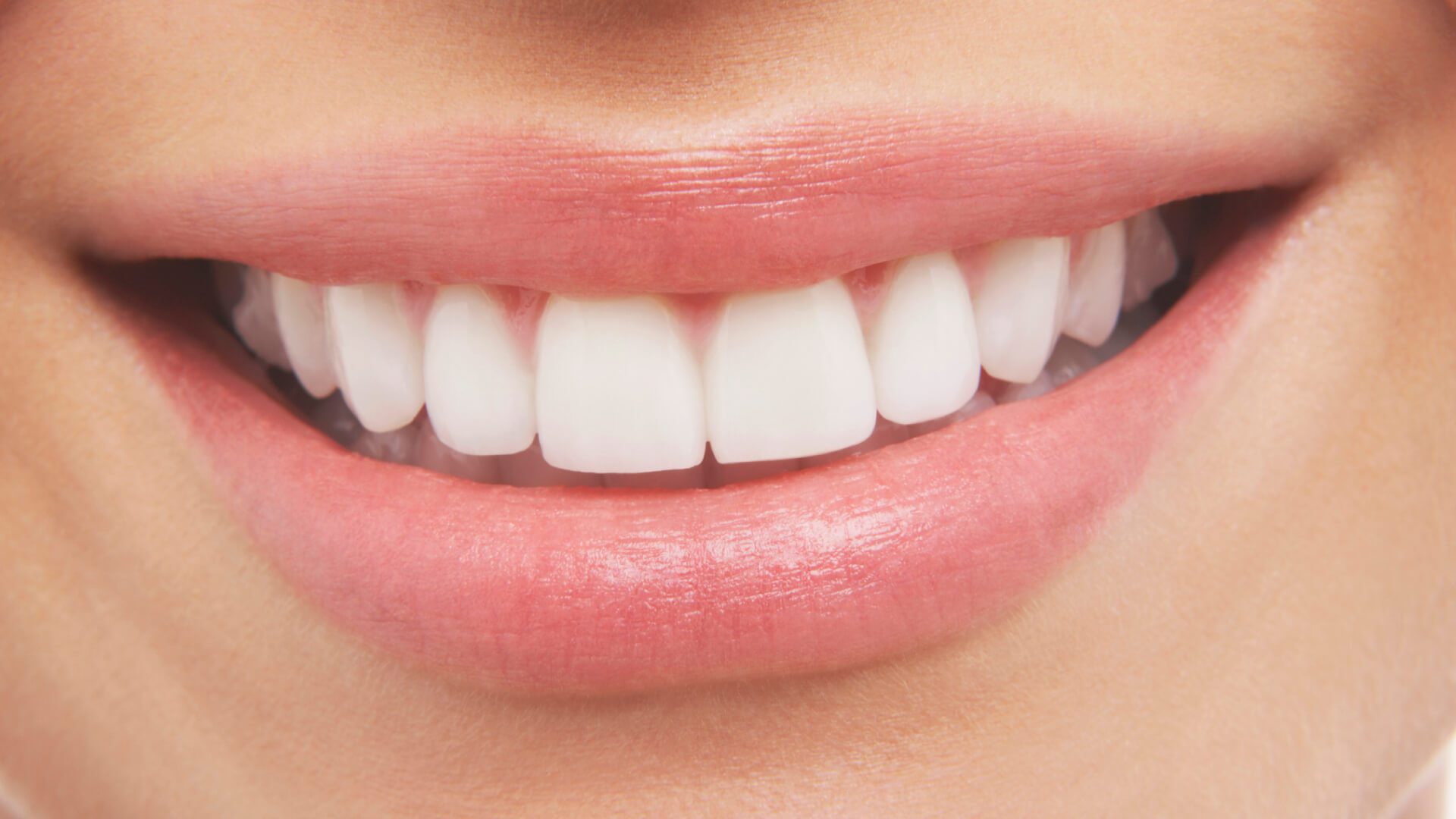 Is Professional Teeth Whitening Worth It? Advanced Dental Care of